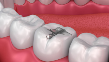 Rimozione protetta delle amalgame dentali